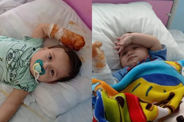 Двухлетний Салех нуждается в помощи: Его нога и рука полностью обожжены - ФОТО
